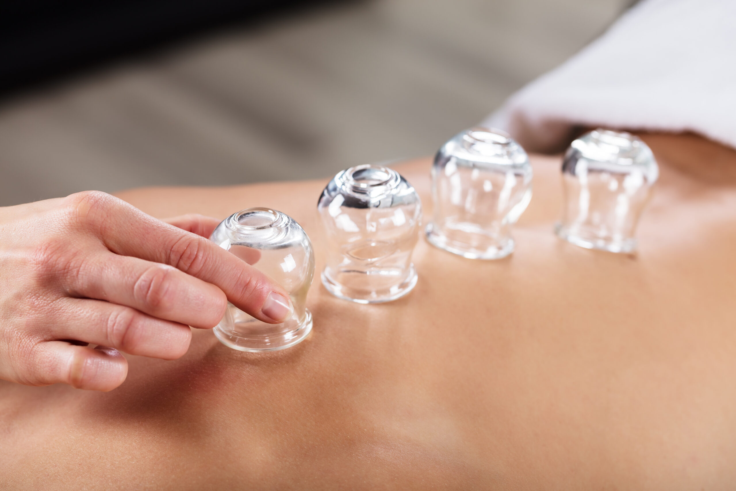 shutterstock_609056195 cupping